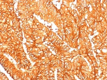 IHC testing of FFPE human colon carcinoma and recombinant Ep-CAM antibody (clone EGP40/1556R). Required HIER: steam sections in pH6 citrate buffer for 10-20 min.~