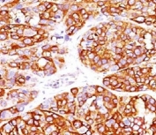 IHC testing of formalin-fixed, paraffin-embedded human melanoma stained with recombinant MART-1 antibody (clone MLANA/1409R). HIER: steam sections in pH 9 10mM Tris with 1mM EDTA for 10-20 min followed by cooling at RT for 20 min.