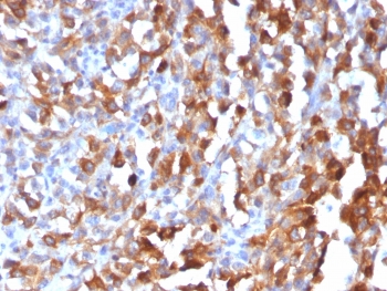 IHC testing of formalin-fixed, paraffin-embedded human melanoma stained with recombinant MART-1 antibody (clone MLANA/1409R). HIER: steam sections in pH 9 10mM Tris with 1mM EDTA for 10-20 min followed by cooling at RT for 20 min.~