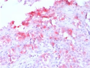 IHC testing FFPE human melanoma with recombinant Melan-A antibody (clone MLANA/1761R). HIER: steam sections in pH 9 10mM Tris with 1mM EDTA for 10-20 min.~