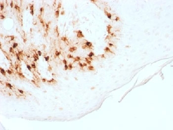 IHC testing of FFPE human melanoma with recombinant Melan-A antibody (clone MLANA