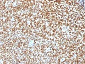 IHC testing of FFPE Ewings sarcoma with recombinant NKX2.2 antibody (clone NX2/1422R). HIER: steam sections in pH 9 10mM Tris with 1mM EDTA for 10-20 min.~