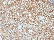 IHC testing of FFPE Ewings sarcoma with recombinant NKX2.2 antibody (clone NX2/1422R). HIER: steam sections in pH 9 10mM Tris with 1mM EDTA for 10-20 min.