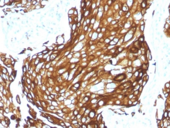IHC staining of FFPE human lung carcinoma with recombinant Acidic Cytokeratin. HIER: boil tissue sections in pH 9 10mM Tris with 1mM EDTA for 10-20 min and allow to cool before testing.~