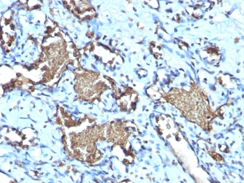 IHC testing of FFPE human angiosarcoma with recombinant Glycophorin A antibody (clone GYPA/1725R). Required HIER: boil tissue sections in pH 9 10mM Tris with 1mM EDTA for 10-20 min.~
