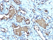 IHC testing of FFPE human angiosarcoma with recombinant Glycophorin A antibody (clone GYPA/1725R). Required HIER: boil tissue sections in pH 9 10mM Tris with 1mM EDTA for 10-20 min.