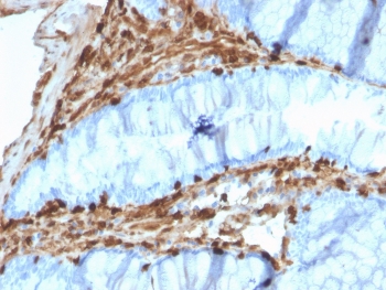 IHC testing of FFPE human colon carcinoma with Annexin A1 antibody (clone CPTC-ANXA1-1). Required HIER: steam section in pH6 citrate buffer for 20 min and allow to cool prior to staining.~