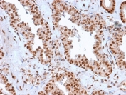 IHC testing of FFPE human prostate carcinoma with APE1 antibody (clone CPTC-APEX1-2). Required HIER: steam section in pH6 citrate buffer for 20 min and allow to cool prior to staining.