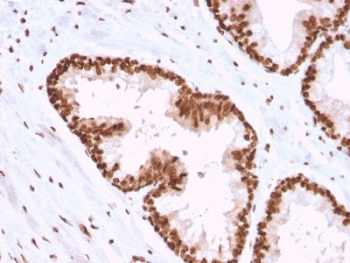 IHC testing of FFPE human prostate carcinoma with A