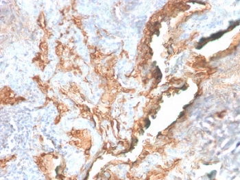 IHC staining of FFPE human lung carcinoma with recombinant Tenascin C antibody (clone TNC/2981R). HIER: boil tissue sections in 10mM Tris with 1mM EDTA, pH 9, for 10-20 min and allow to cool before testing.~