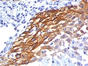 IHC testing of FFPE human cervical carcinoma stained with RPSA antibody (clone LMNR-1). Required HIER: boiling tissue sections in pH 9 10mM Tris with 1mM EDTA for 10-20 min followed by cooling at RT for 20 min.