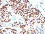 IHC staining of FFPE human gastric carcinoma with CD123 antibody. HIER: boil tissue sections in 10mM Tris with 1mM EDTA, pH 9 for 10-20 min and allow to cool.
