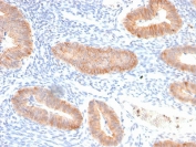 IHC staining of FFPE human endocervical carcinoma with recombinant IL-10 antibody (clone IL10/2651R). HIER: boil tissue sections in pH 9 10mM Tris with 1mM EDTA for 10-20 min and allow to cool before testing.