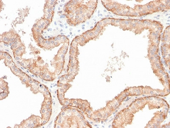 IHC staining of FFPE human prostate carcinoma with recombinant IL-10 antibody (clone IL10/2651R). HIER: boil tissue sections in pH 9 10mM Tris with 1mM EDTA for 10-20 min and allow to cool before testing.~