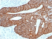 IHC staining of FFPE human colon carinoma with recombinant Cytokeratin 18 antibody (clone KRT18/2819R). Required HIER: boil tissue sections in pH 9 10mM Tris with 1mM EDTA for 10-20 min and allow to cool before testing.
