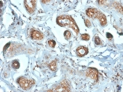 IHC testing of FFPE human breast carcinoma stained with RPSA antibody (clone RPSA/2699). Required HIER: boiling tissue sections in pH 9 10mM Tris with 1mM EDTA for 10-20 min followed by cooling at RT for 20 min.