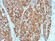 IHC testing of FFPE human colon carcinoma stained with RPSA antibody (clone RPSA/2699). Required HIER: boiling tissue sections in pH 9 10mM Tris with 1mM EDTA for 10-20 min followed by cooling at RT for 20 min.