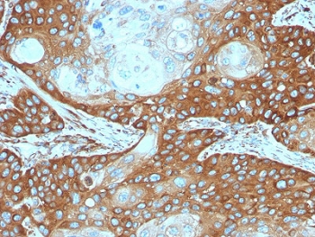 IHC testing of FFPE human cervical carcinoma stained with RPSA antibody. Required HIER: boiling tissue sections in pH 9 10mM Tris with 1mM EDTA for 10-20 min followed by cooling at RT for 20 min.