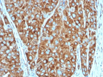 IHC testing of FFPE human colon carcinoma stained with RPSA antibody. Required HIER: boiling tissue sections in pH 9 10mM Tris with 1mM EDTA for 10-20 min followed by cooling at RT for 20 min.