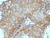 IHC testing of FFPE human basal cell carcinoma stained with RPSA antibody (clone RPSA/2699). Required HIER: boiling tissue sections in pH 9 10mM Tris with 1mM EDTA for 10-20 min followed by cooling at RT for 20 min.