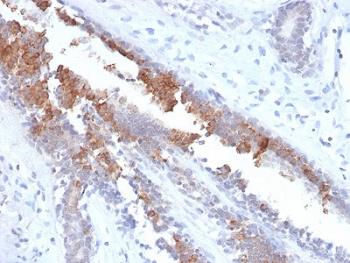 IHC testing of FFPE human breast carcinoma stained with recombinant Mammaglobin antibody (clone MGB/2123R). Required HIER: boiling tissue sections in 10mM citrate buffer, pH6, for 10-20 min followed by cooling at RT for 20 min.~