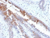 IHC testing of FFPE human breast carcinoma stained with recombinant Mammaglobin antibody (clone MGB/2123R). Required HIER: boiling tissue sections in 10mM citrate buffer, pH6, for 10-20 min followed by cooling at RT for 20 min.