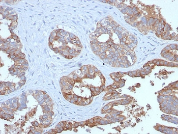 IHC testing of FFPE human prostate carcinoma with recombinant MUC1 antibody. Required HIER: boil tissue sections in pH 9 10mM Tris with 1mM EDTA for 10-20 min followed by cooling at RT for 20 min.~