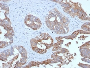 IHC testing of FFPE human prostate carcinoma with recombinant MUC1 antibody (clone MUC1/2729R). Required HIER: boil tissue sections in pH 9 10mM Tris with 1mM EDTA for 10-20 min followed by cooling at RT for 20 min.