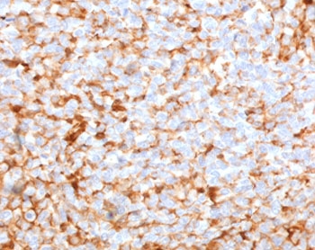 IHC testing of FFPE human breast carcinoma stained with r