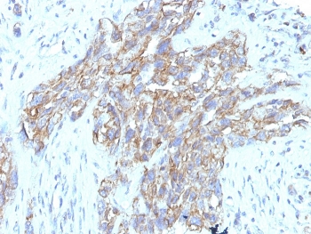 IHC staining of FFPE human lung carcinoma tissue with CD56 antibody (clone 123C3.D5 + 123A8). HIER: boil tissue sections in pH9 EDTA buffer for 10-20 min followed by cooling at RT for 20 min.~