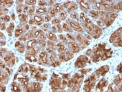 IHC testing of FFPE human stomach carcinoma with recombinant Mucin-1 antibody (clone MUC1/2818R). Required HIER: boil tissue sections in pH 9 10mM Tris with 1mM EDTA for 10-20 min followed by cooling at RT for 20 min.