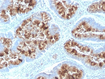 IHC testing of FFPE human colon with recombinant Mucin-1 antibody (clone MUC1/2818R). Required HIER: boil tissue sections in pH 9 10mM Tris with 1mM EDTA for 10-20 min followed by cooling at RT for 20 min.~