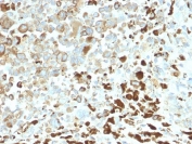 IHC testing of FFPE human melanoma tissue with recombinant NGFR antibody (clone NGFR/2550R). Required HIER: boil tissue sections in pH6, 10mM citrate buffer, for 10-20 min and allow to cool prior to testing.
