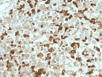 IHC testing of FFPE human melanoma tissue with recombinant NGFR antibody. Required HIER: boil tissue sections in pH6, 10mM citrate buffer, for 10-20 min and allow to cool prior to testing.~
