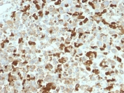 IHC testing of FFPE human melanoma tissue with recombinant NGFR antibody (clone NGFR/2550R). Required HIER: boil tissue sections in pH6, 10mM citrate buffer, for 10-20 min and allow to cool prior to testing.