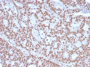 IHC staining of FFPE human endometrial carcinoma with Progesterone Receptor antibody (clone PGR/2694). HIER: boil tissue sections in pH6, 10mM citrate buffer, for 10-20 min and allow to cool before testing.~