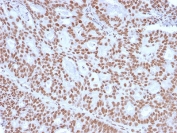 IHC staining of FFPE human endometrial carcinoma with Progesterone Receptor antibody (clone PGR/2694). HIER: boil tissue sections in pH6, 10mM citrate buffer, for 10-20 min and allow to cool before testing.