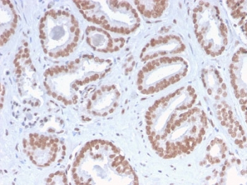 IHC staining of FFPE human prostate carcinoma with recombinant ATRX antibody. HIER: boil tissue sections in 10mM Tris with 1mM EDTA buffer, pH 9, for 10-20 min followed by cooling at RT for 20 min.~