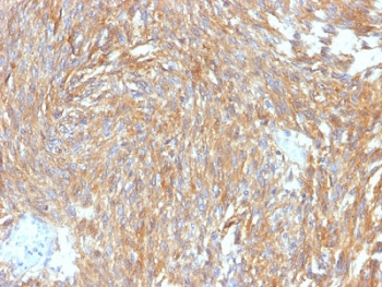 IHC testing of FFPE human gastrointestinal stromal tumor (GIST) with DOG1 antibody (clone DG1/2564R). Required HIER: boil tissue sections in pH 9 10mM Tris with 1mM EDTA for 10-20 min followed by cooling at RT for 20 min.~