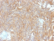 IHC testing of FFPE human gastrointestinal stromal tumor (GIST) with DOG1 antibody (clone DG1/2564R). Required HIER: boil tissue sections in pH 9 10mM Tris with 1mM EDTA for 10-20 min followed by cooling at RT for 20 min.