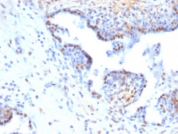 IHC staining of FFPE human colon carcinoma with RAD51 antibody. HIER: boil tissue sections in pH6, 10mM citrate buffer, for 10-20 min and allow to cool before testing.~