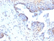 IHC staining of FFPE human colon carcinoma with RAD51 antibody (clone RAD51/2765). HIER: boil tissue sections in pH6, 10mM citrate buffer, for 10-20 min and allow to cool before testing.