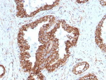 IHC staining of FFPE human prostate carcinoma with TMEPAI antibody (clone PMEPA1/2698). HIER: boil tissue sections in pH6, 10mM citrate buffer, for 10-20 min and allow to cool before testing.~