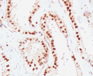 IHC staining of FFPE human colon carcinoma with RAD51 antibody (clone RALPA-1). HIER: boil tissue sections in pH 9 10mM Tris with 1mM EDTA for 10-20 min and allow to cool before testing.