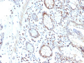IHC staining of FFPE human colon carcinoma with RAD51 antibody. HIER: boil tissue sections in pH6, 10mM citrate buffer, for 10-20 min and allow to cool before testing.