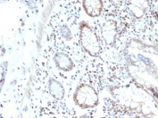 IHC staining of FFPE human colon carcinoma with RAD51 antibody (clone RAD51/2702). HIER: boil tissue sections in pH6, 10mM citrate buffer, for 10-20 min and allow to cool before testing.