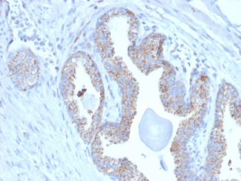 IHC staining of FFPE human prostate carcinoma with TMEPAI antibody (clone PMEPA1/2697). HIER: boil tissue sections in pH 9 10mM Tris with 1mM EDTA for 10-20 min and allow to cool before testing.~