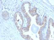IHC staining of FFPE human prostate carcinoma with TMEPAI antibody (clone PMEPA1/2697). HIER: boil tissue sections in pH 9 10mM Tris with 1mM EDTA for 10-20 min and allow to cool before testing.