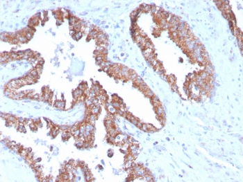 IHC staining of FFPE human prostate carcinoma with TMEPAI antibody (clone PMEPA1/2696). HIER: boil tissue sections in pH6, 10mM citrate buffer, for 10-20 min and allow to cool before testing.~
