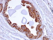 IHC staining of FFPE human prostate carcinoma with TMEPAI antibody (clone PMEPA1/2696). HIER: boil tissue sections in pH6, 10mM citrate buffer, for 10-20 min and allow to cool before testing.